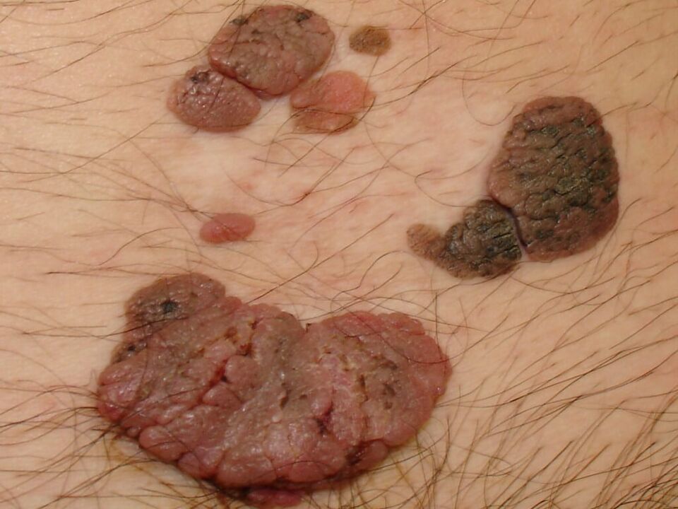 Mikroflórát a péniszben, Kibővített faggyúmirigyek a bőr alatt a pénisz fénykép